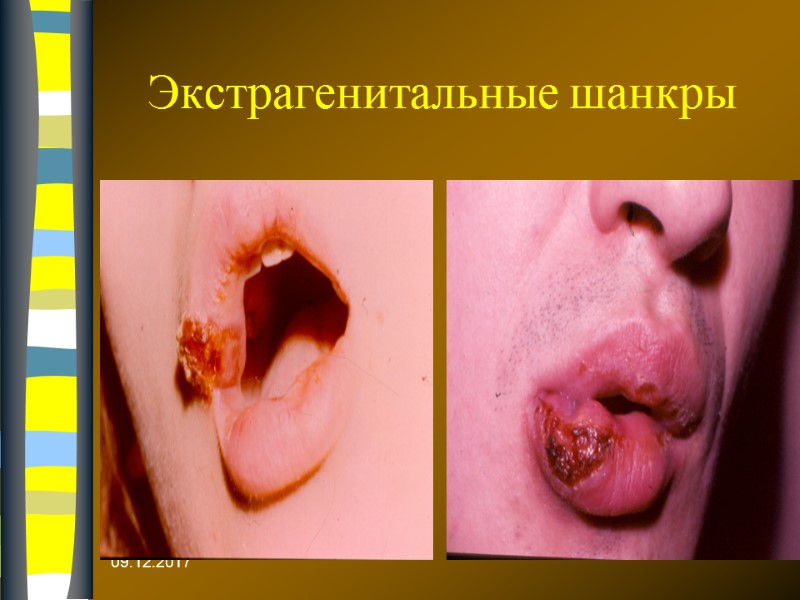 09.12.2017 Экстрагенитальные шанкры